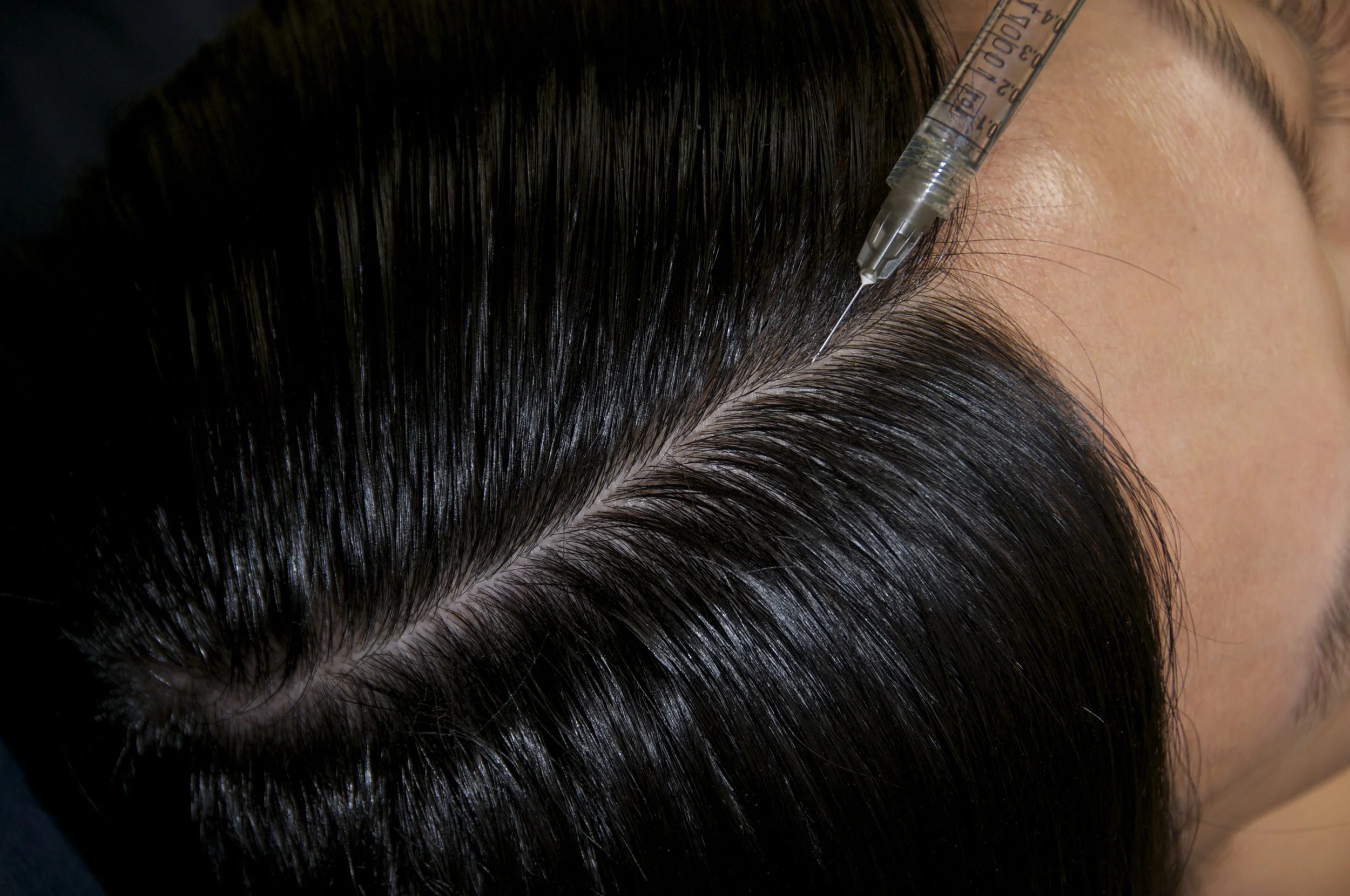 Hair Loss Treatments London
