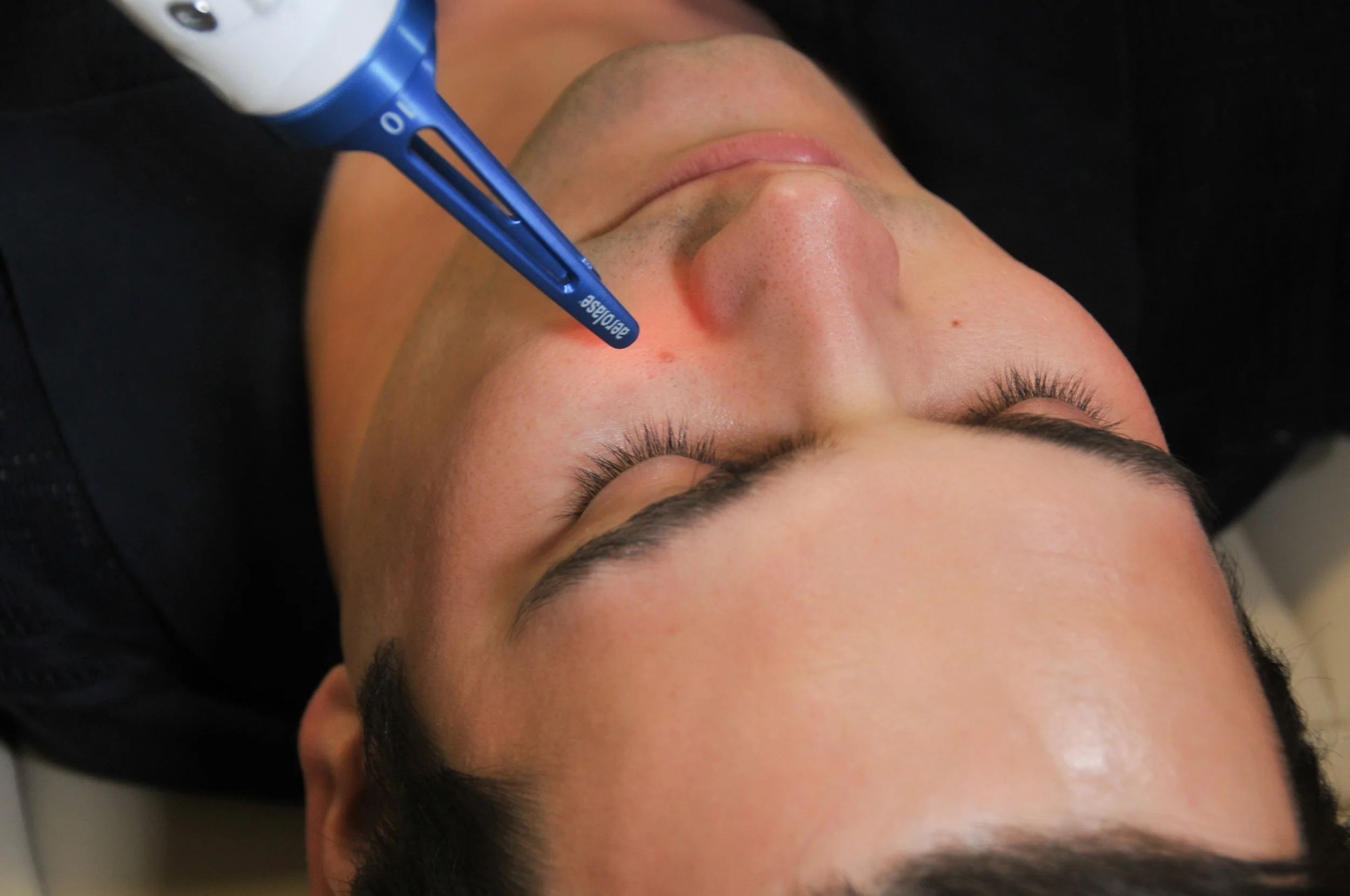 Aerolase Reverse Treatment