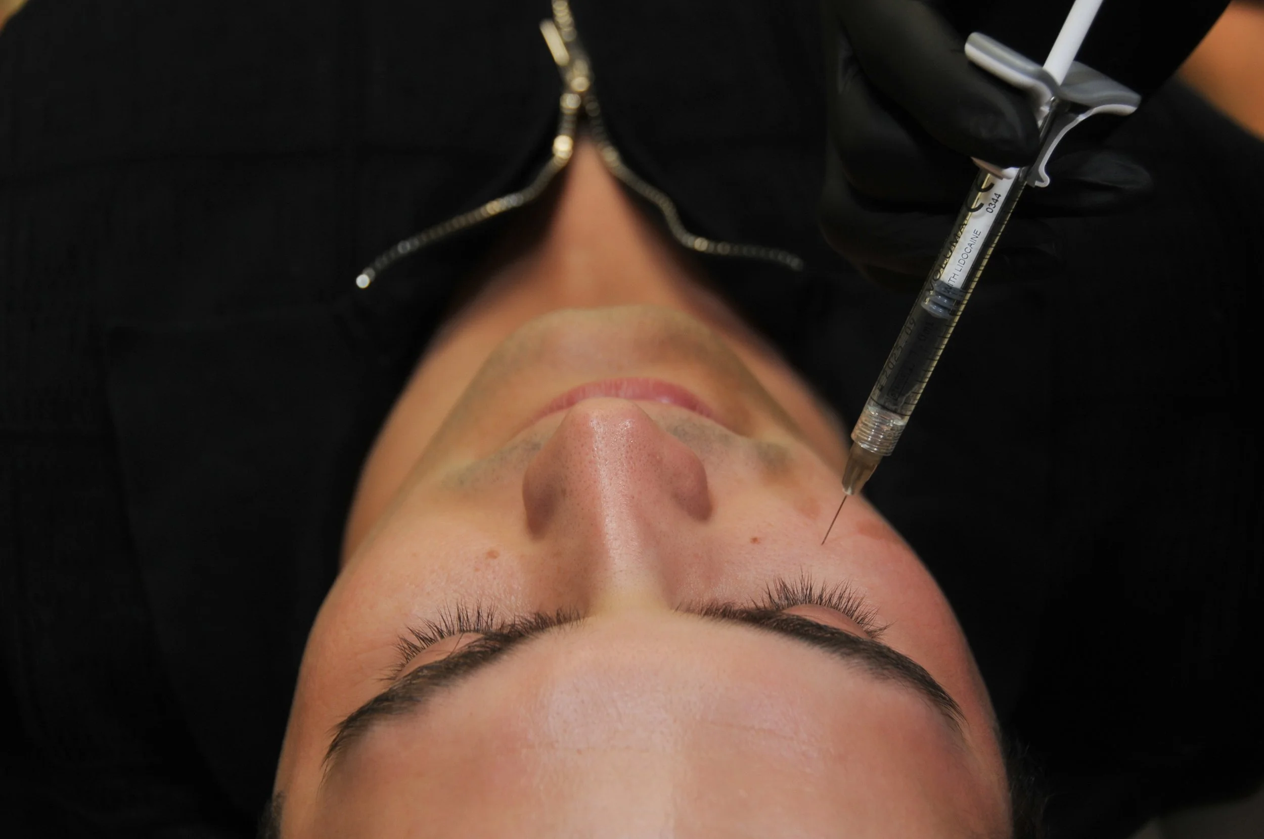Dermal Fillers