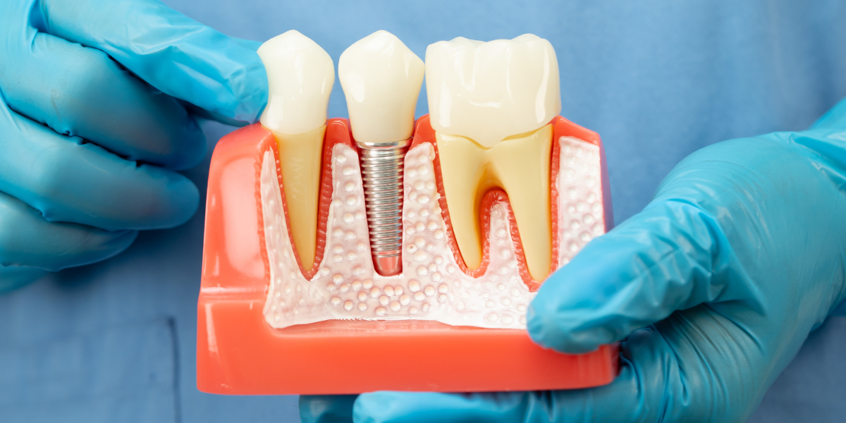 Implants - Elmwood Dental
