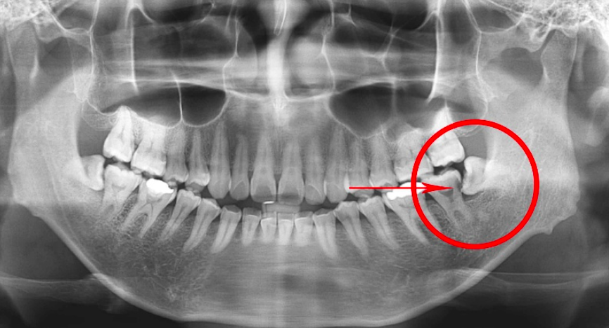 Wisdom teeth removal - Elmwood Dental