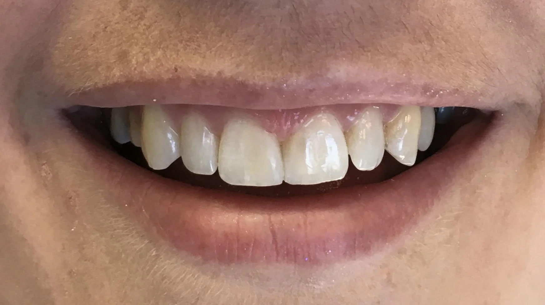 Composite veneers/ closing a gap( diasthema) between teeth