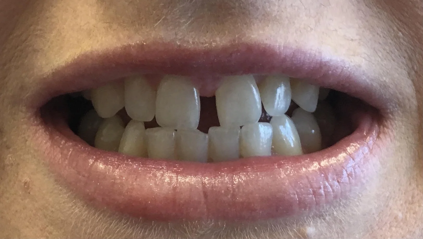 Composite veneers/ closing a gap( diasthema) between teeth