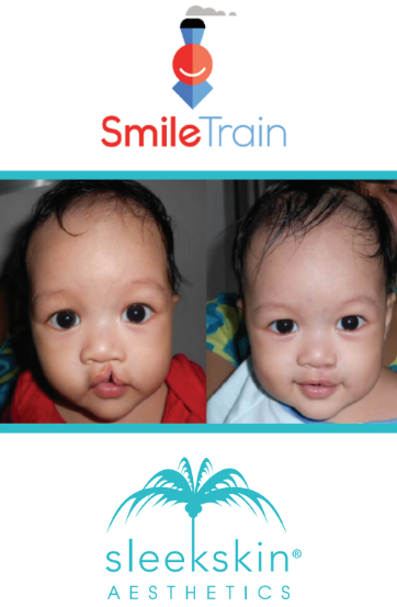 Sleekskin AZ + SmileTrain