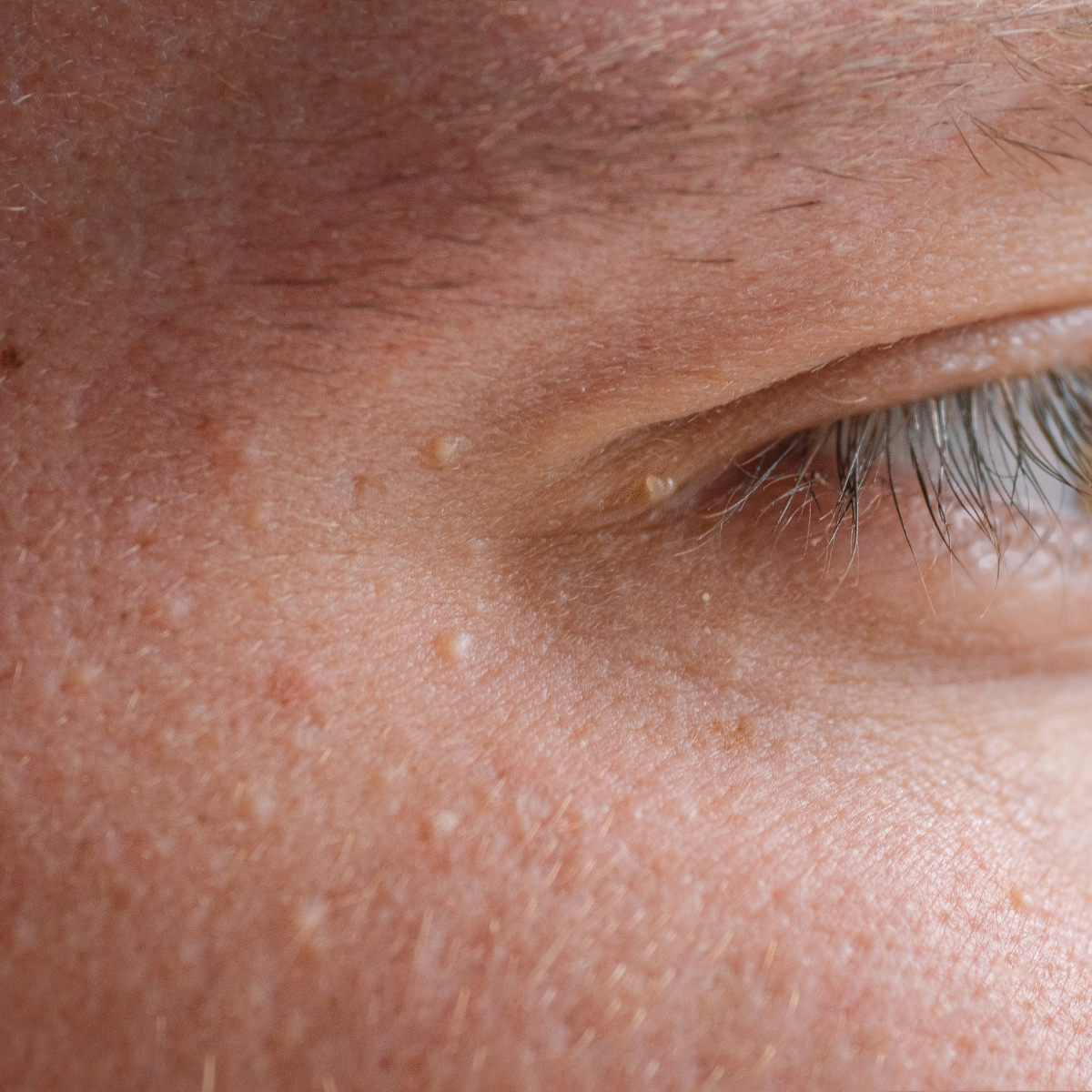 What is Milia and How Do I Get Rid of It?!