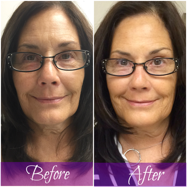 Sleekskin Aesthetics Client Experience – Molly