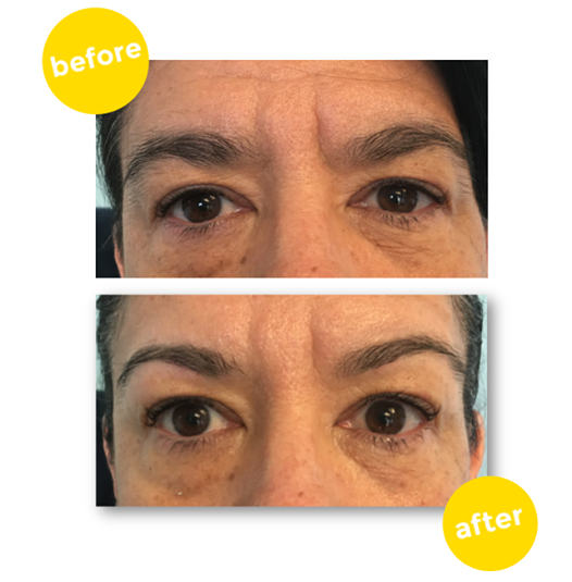 Sleekskin Before/After