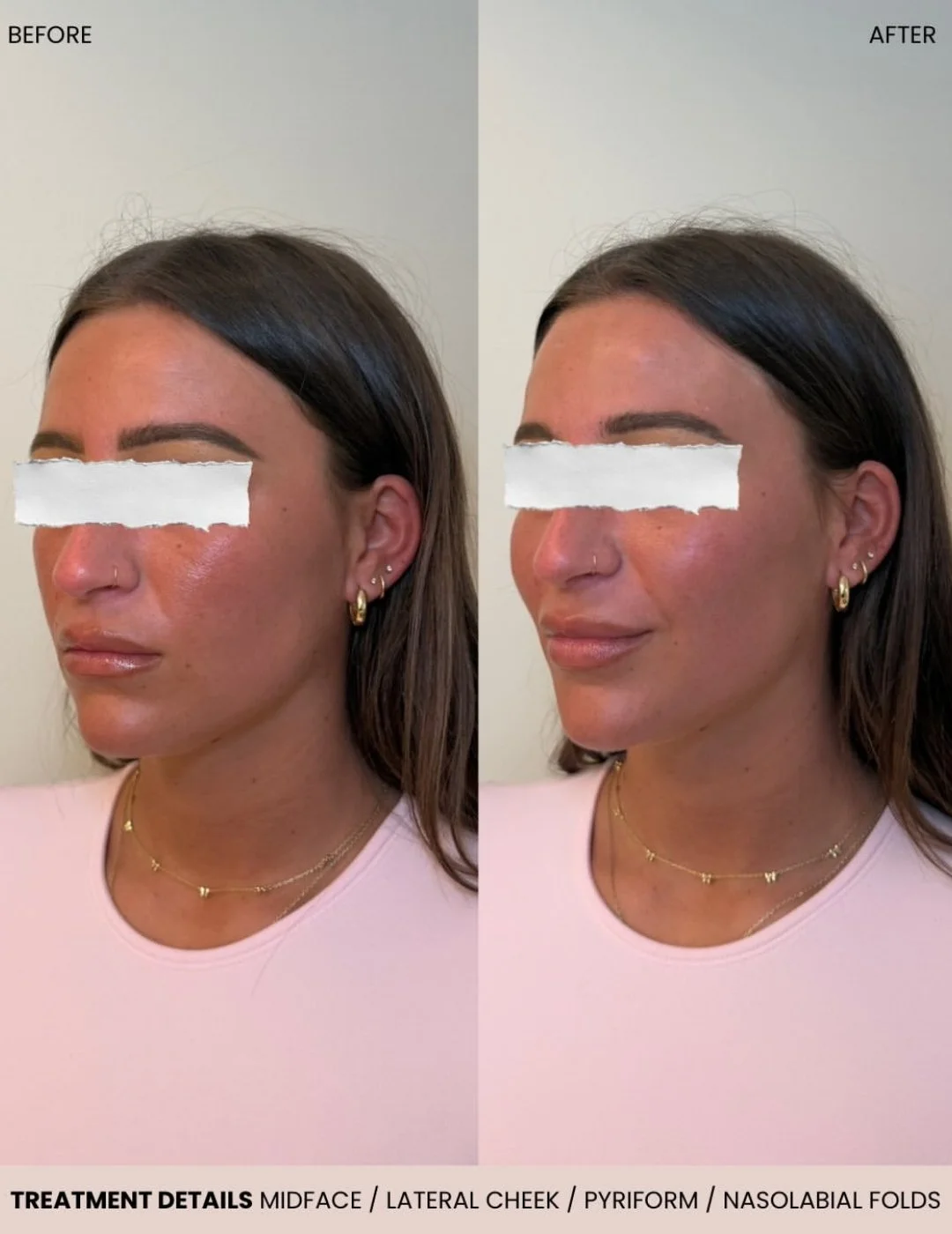 Facial filler before and after results at Aura Aesthetics & Wellness