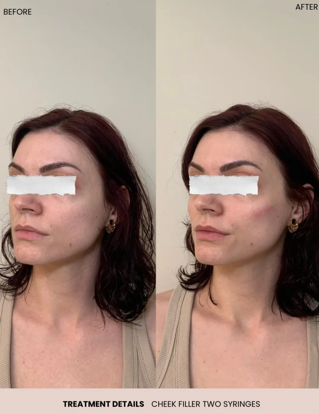 Cheek filler before and after results at Aura Aesthetics & Wellness