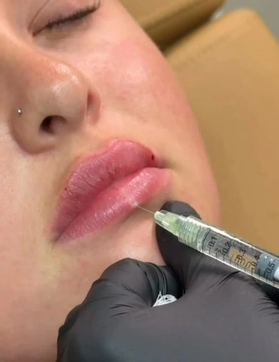 Lip filler treatment at Aura Aesthetics & Wellness in Staten Island