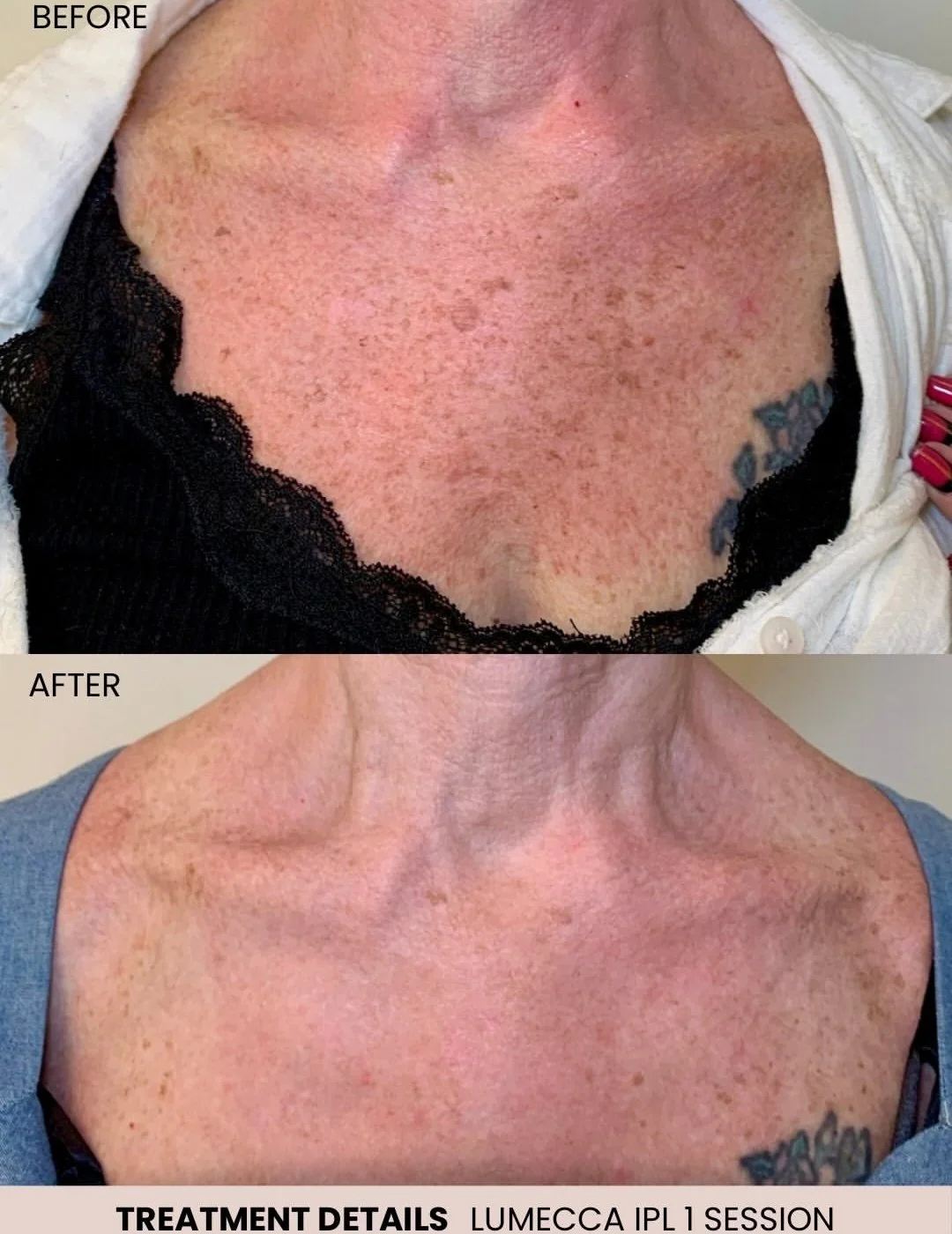 Lumecca IPL before and after results for neck pigmentation