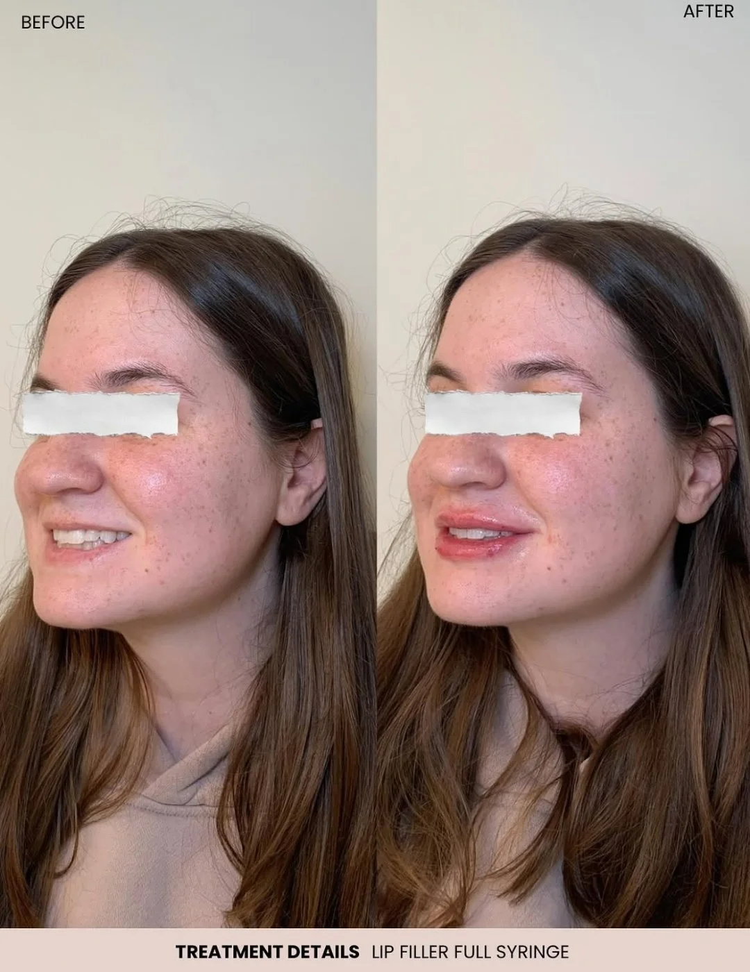 Lip filler before and after results at Aura Aesthetics & Wellness