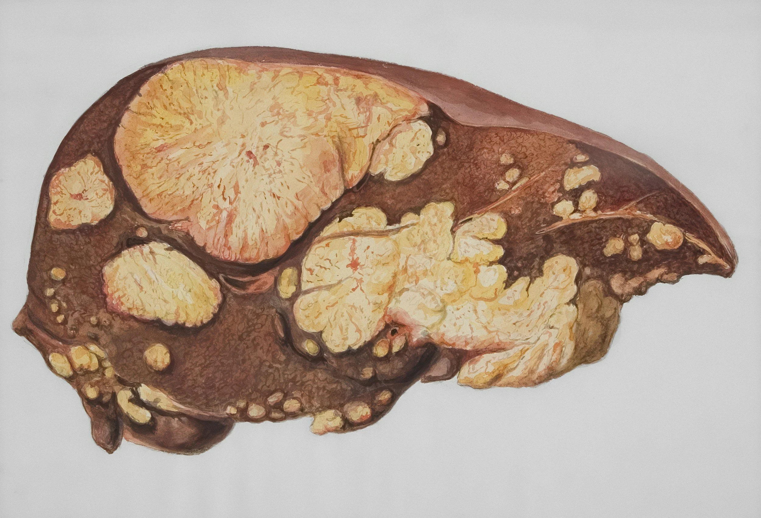 New Study Reveals How GDF15 Protects the Liver in MASH, Independent of Weight Loss
