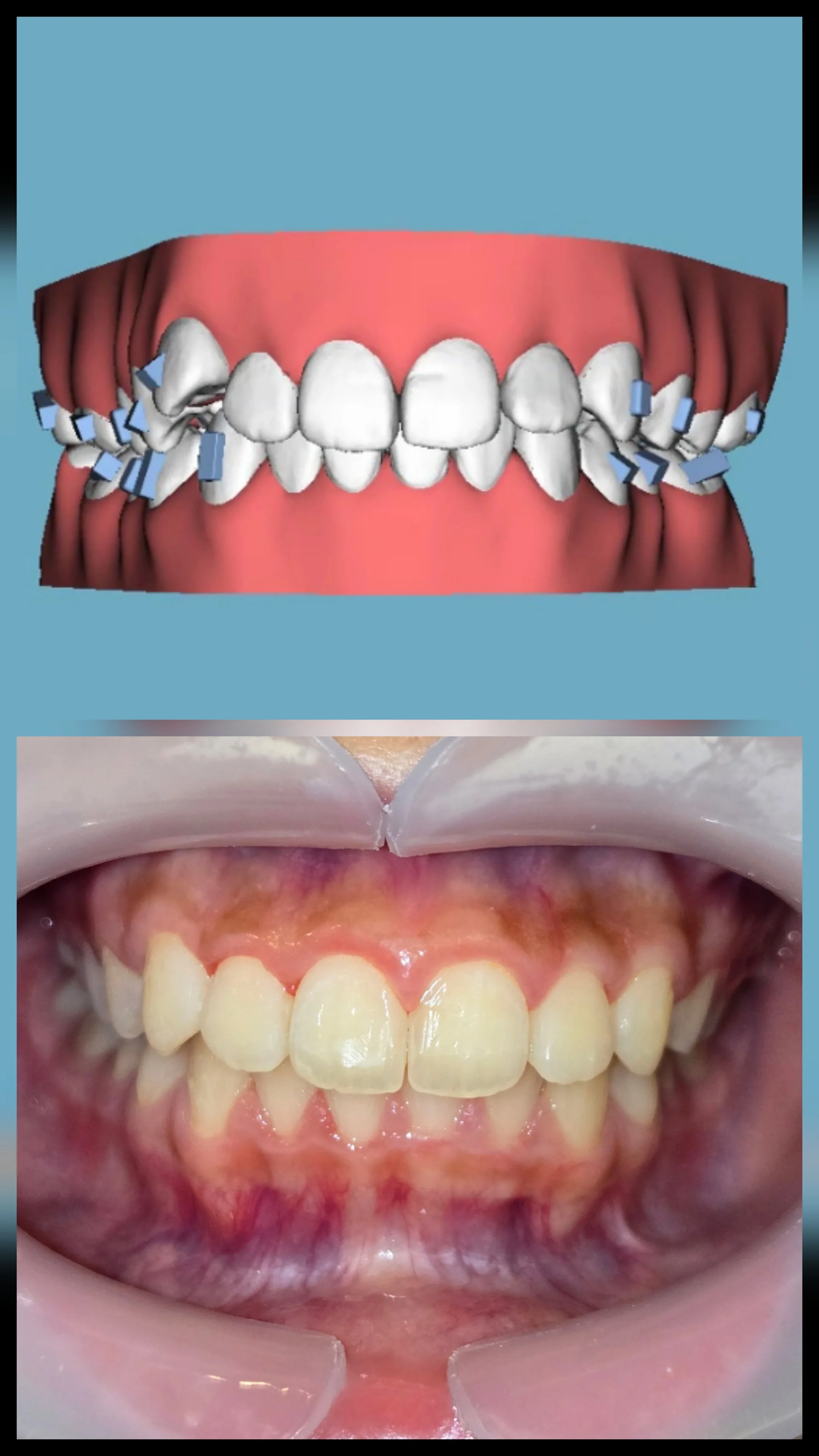 from AI predictable image to finished case  Aligner orthodontic treatment