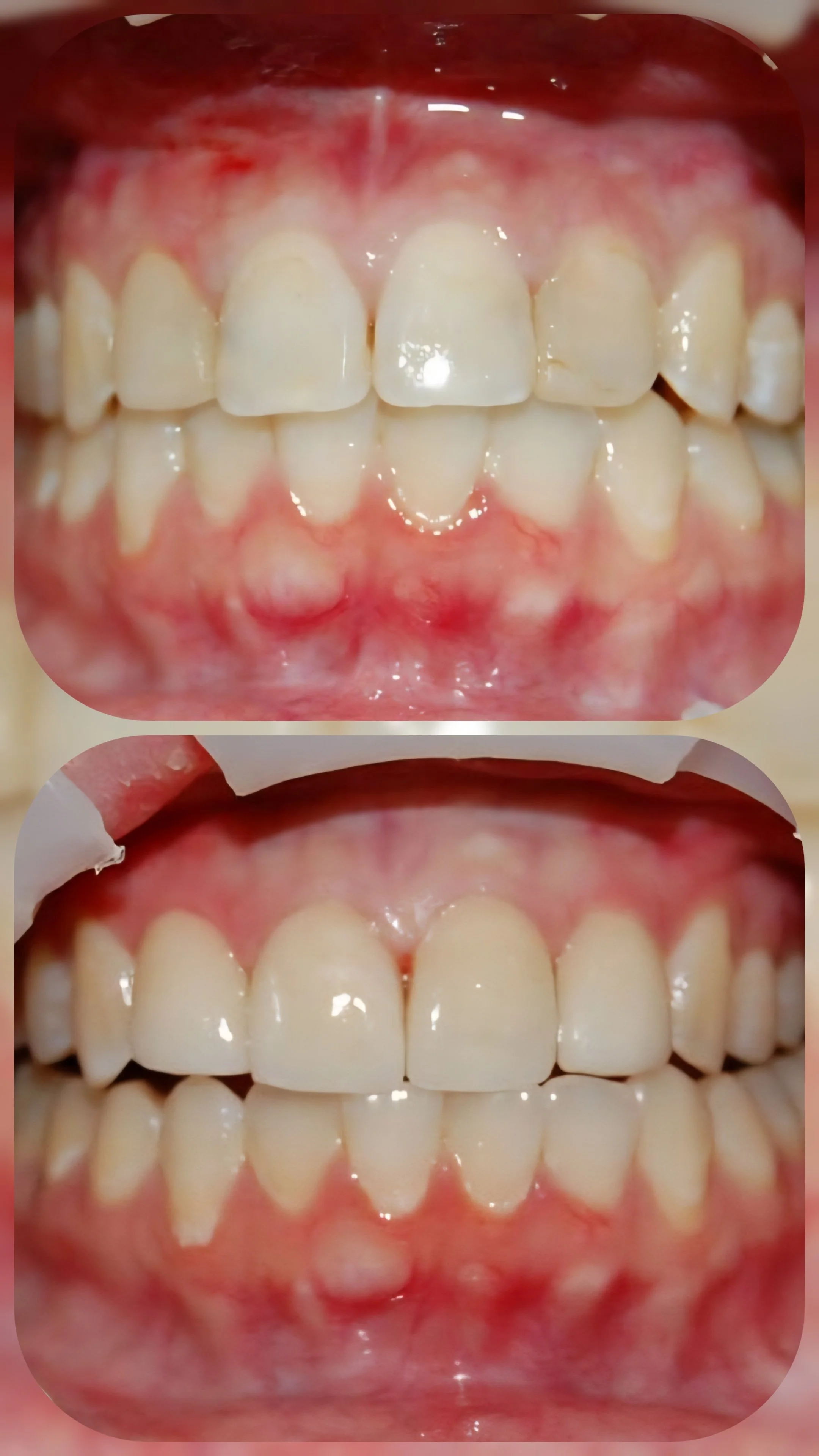 Restorative filling done in one day
