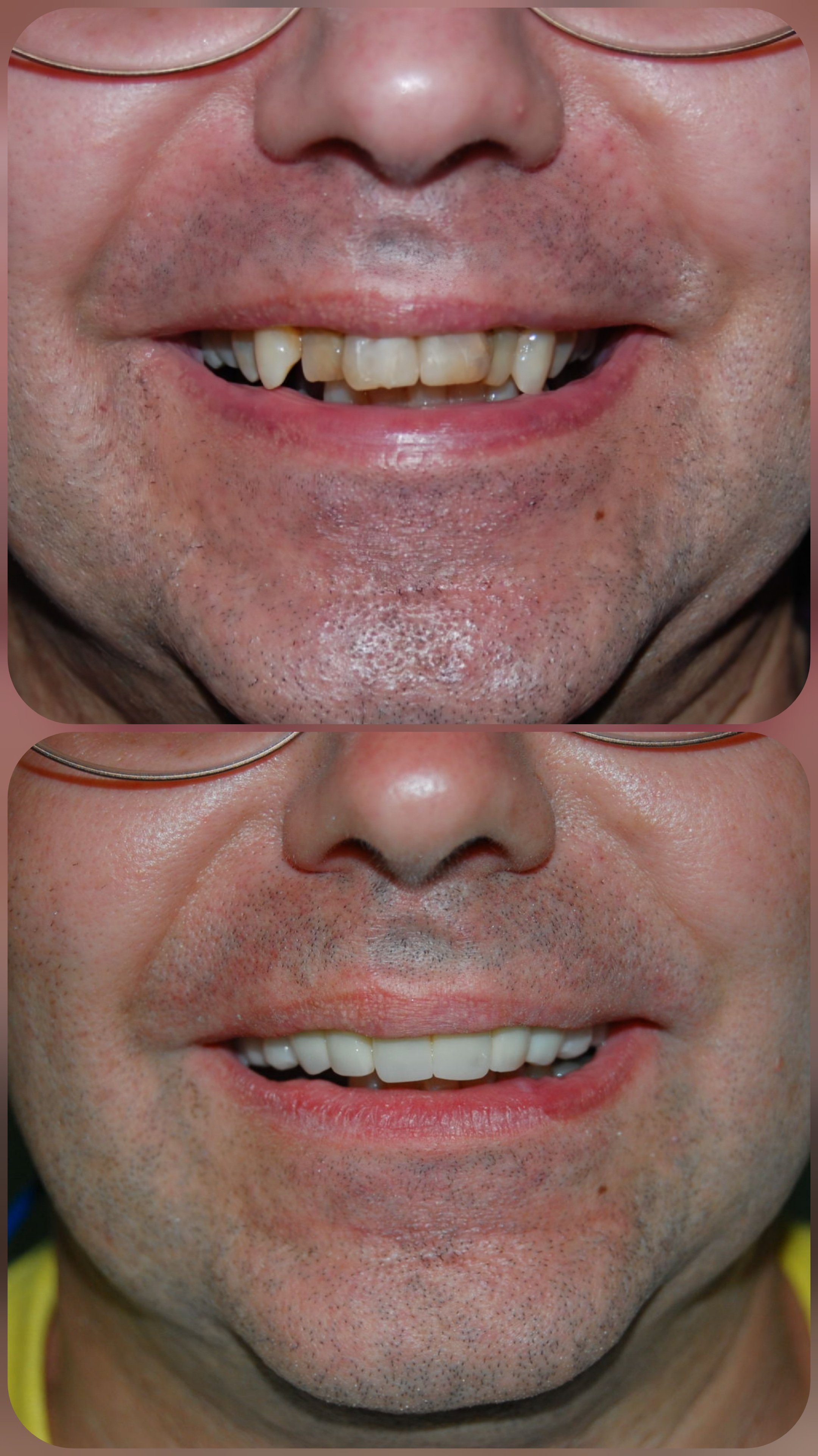 Full anterior crown replacement