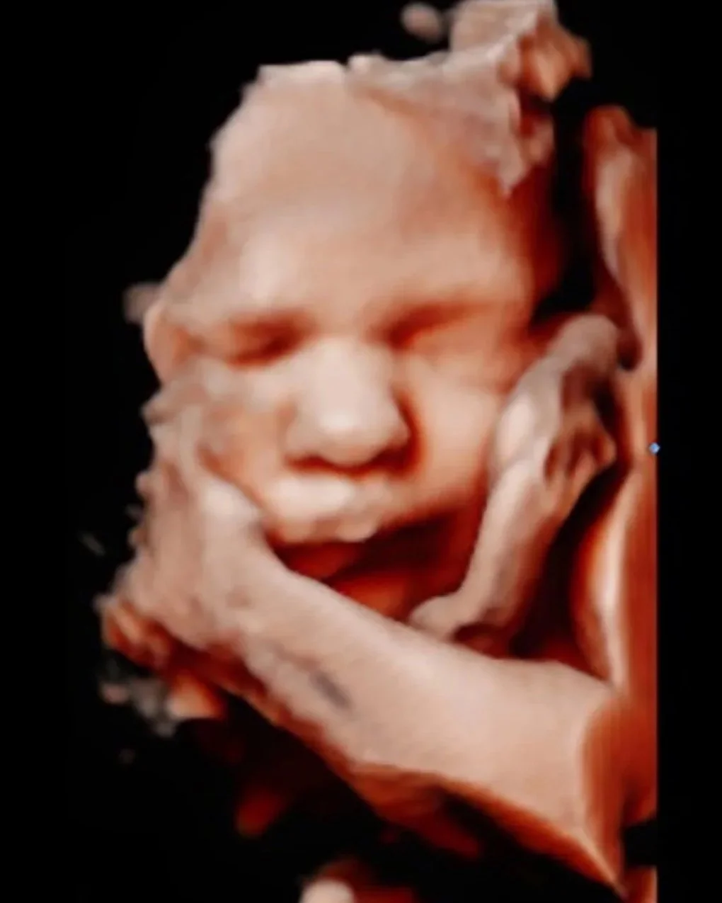 3D ultrasound image of a fetus with closed eyes, resting its head on its hand.