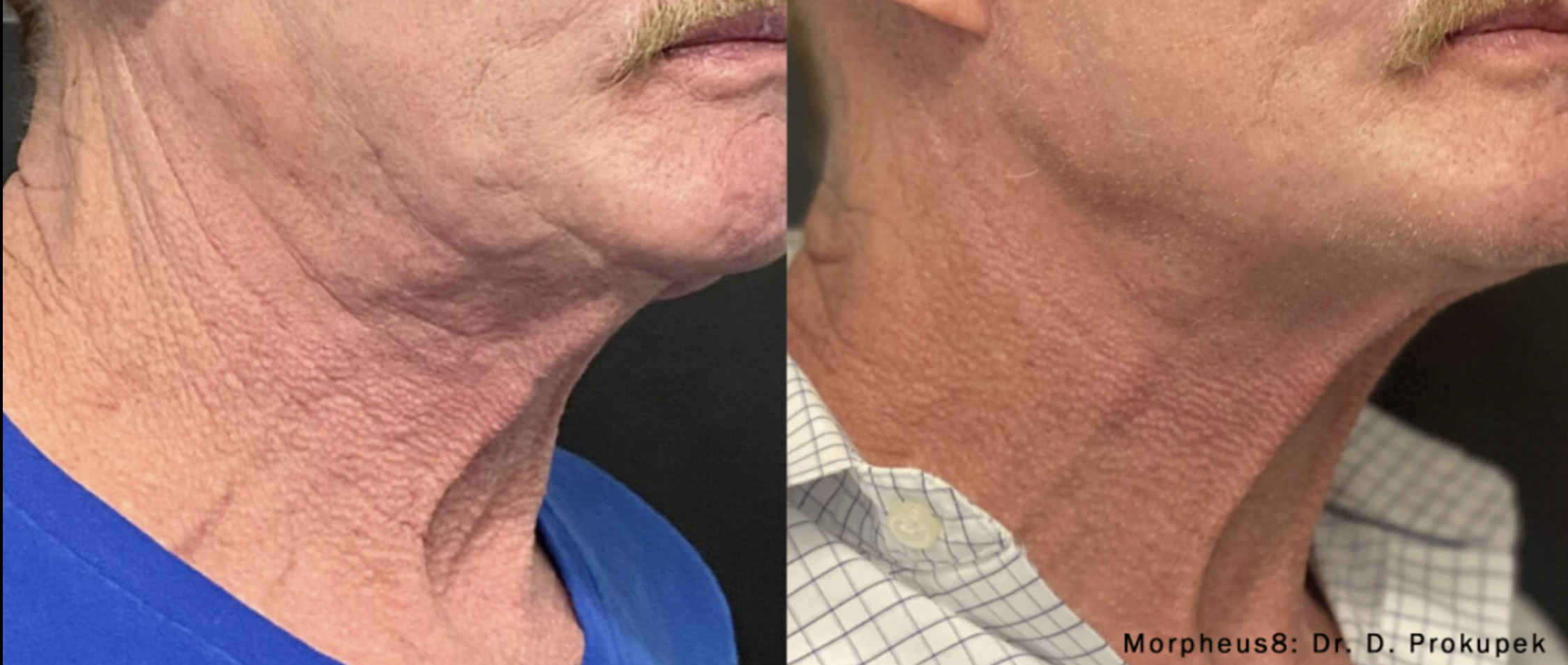 Comparison of a person's neck and chin area before and after a Morpheus8 treatment at Knoxville's Wellness from Within, showing reduced wrinkles and improved skin texture on the right.