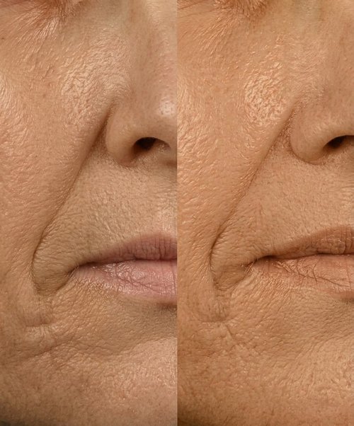 Before and after Anti-Oxidant Topical Biostim, baseline vs after 3 treatments