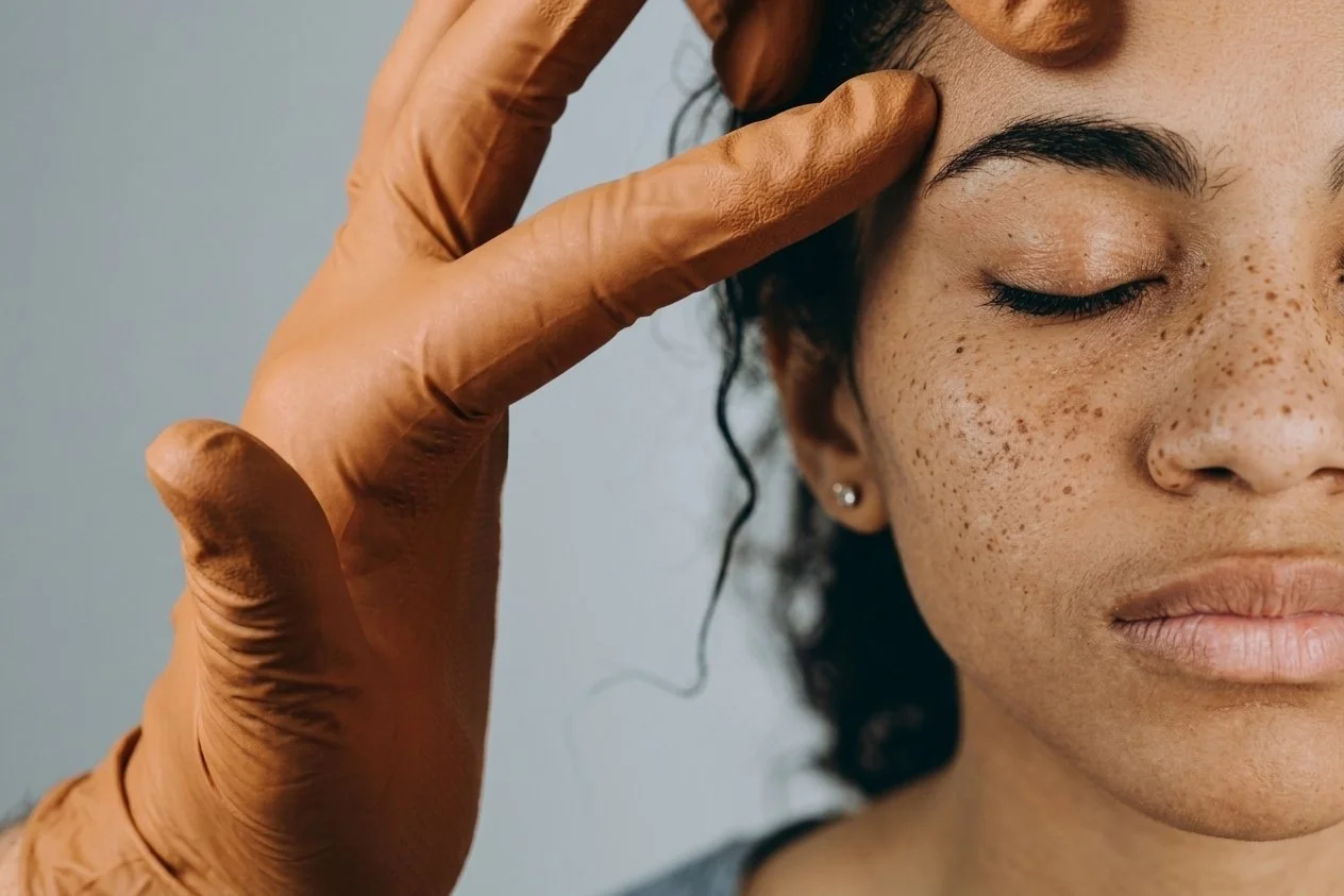 Pigmentation Treatment at Solunexa Medispa