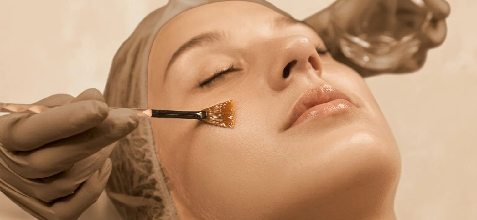 chemical peels - solunexamedispas