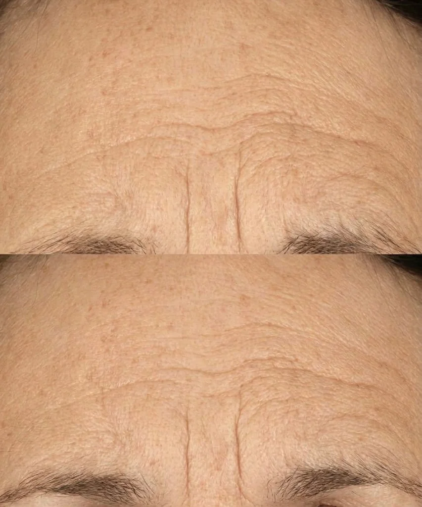 Anti-Oxidant Topical Biostim treatment at Solunexa Medispa