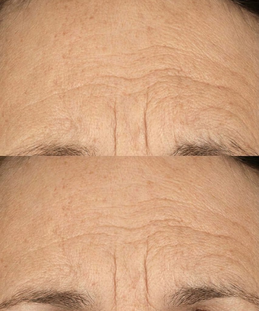 Anti-Oxidant Topical Biostim treatment at Solunexa Medispa