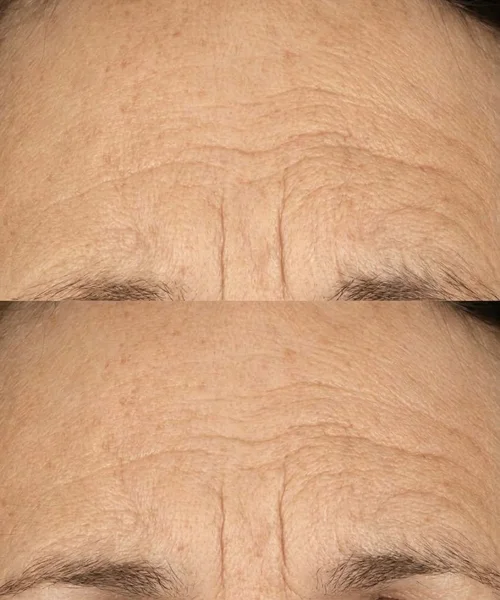 Before and after Anti-Oxidant Topical Biostim, base vs after 2 treatments