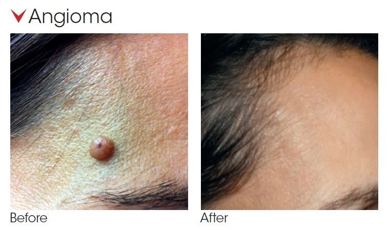 Cherry Angiomas-1.jpg