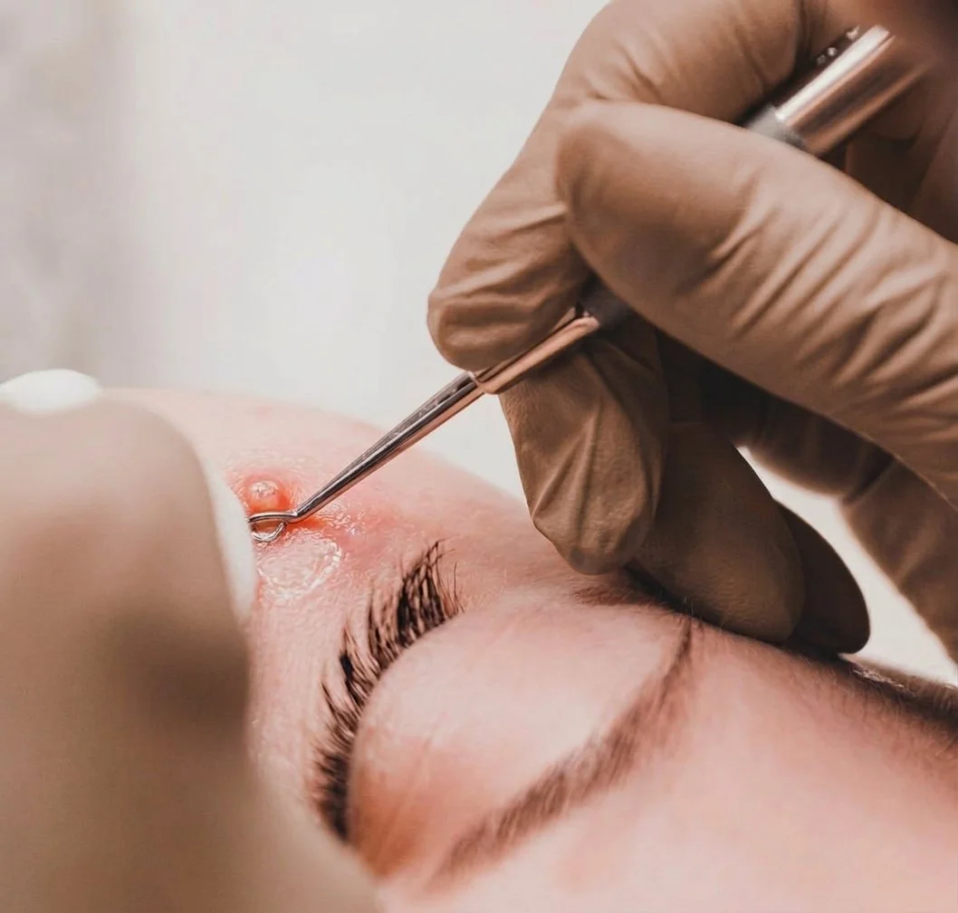 milia treatment.jpg