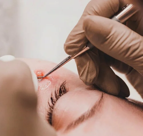 Milia Treatment at Solunexa Medispa