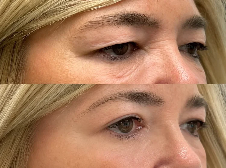 blepharoplasty - solunexamedispas
