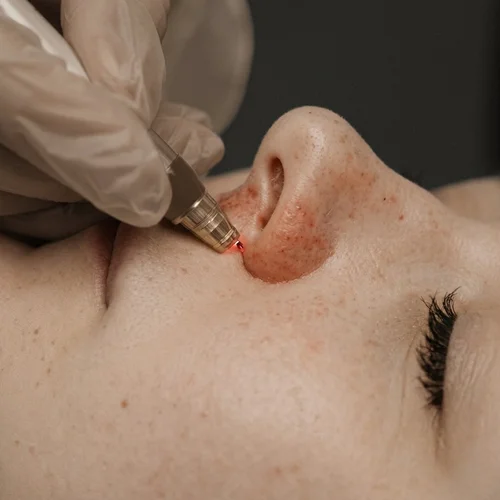 Thread Vein Treatment at Solunexa Medispa