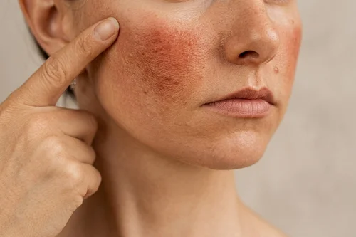 Rosacea Treatment at Solunexa Medispa