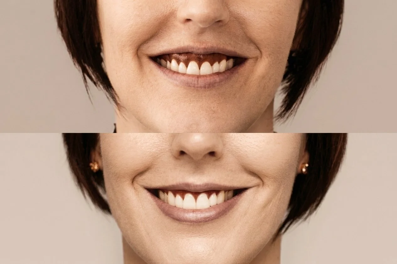 gummy smile.jpg