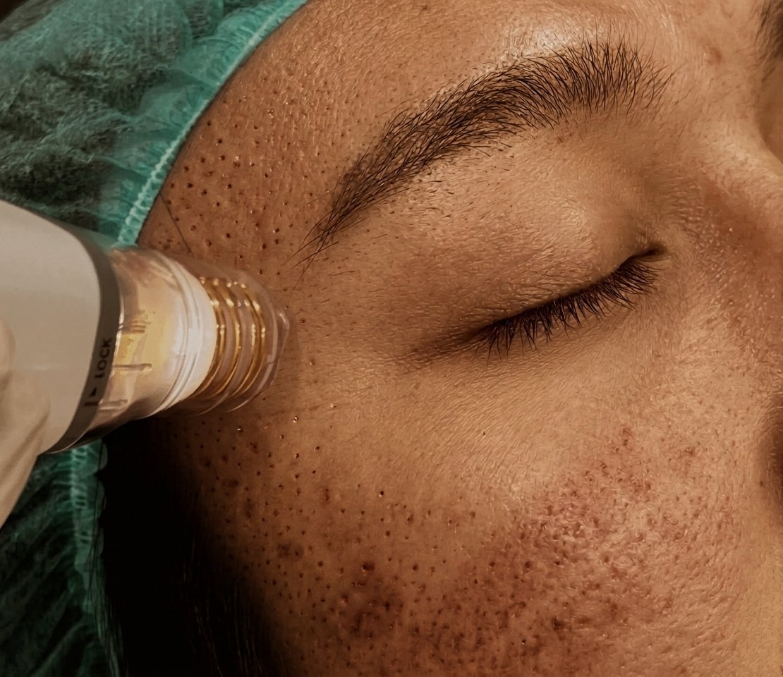 scar treatment.jpg