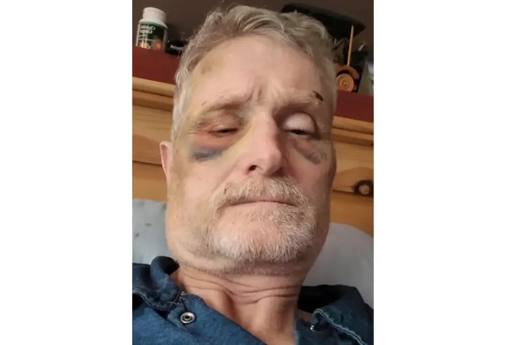 A middle-aged man with short gray hair and facial scars, lying in bed with a wooden headboard behind him, wearing a blue shirt.