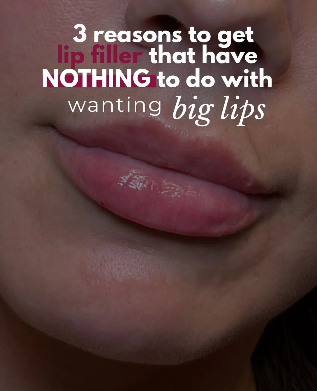 Sometimes lip filler has nothing to do with wanting big lips 

It can be used to:

Smooth lip lines &mdash; soften vertical lines + create a smoother appearance.

Improve symmetry &mdash; balance subtle asymmetries between the upper + lower lip or fr