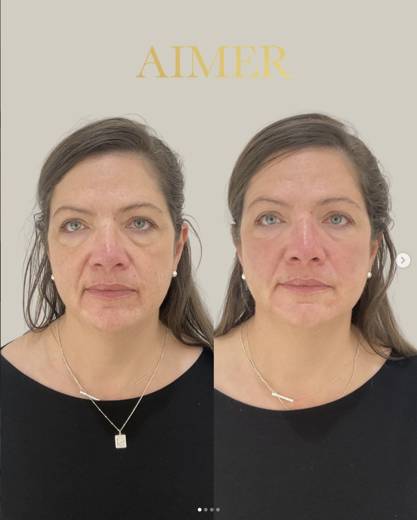Side-by-side comparison of a woman before and after a cosmetic treatment, showing improved skin texture and reduced redness.