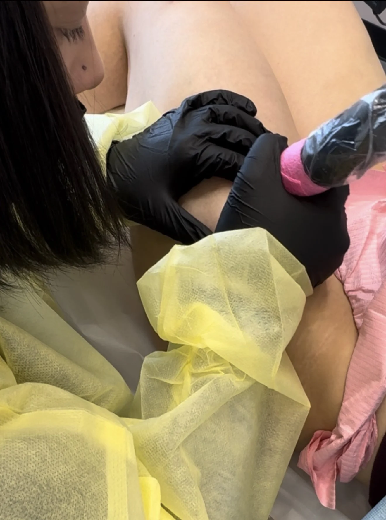 Inkless stretch mark revision treatment being performed on thigh stretch marks in Edmonton.