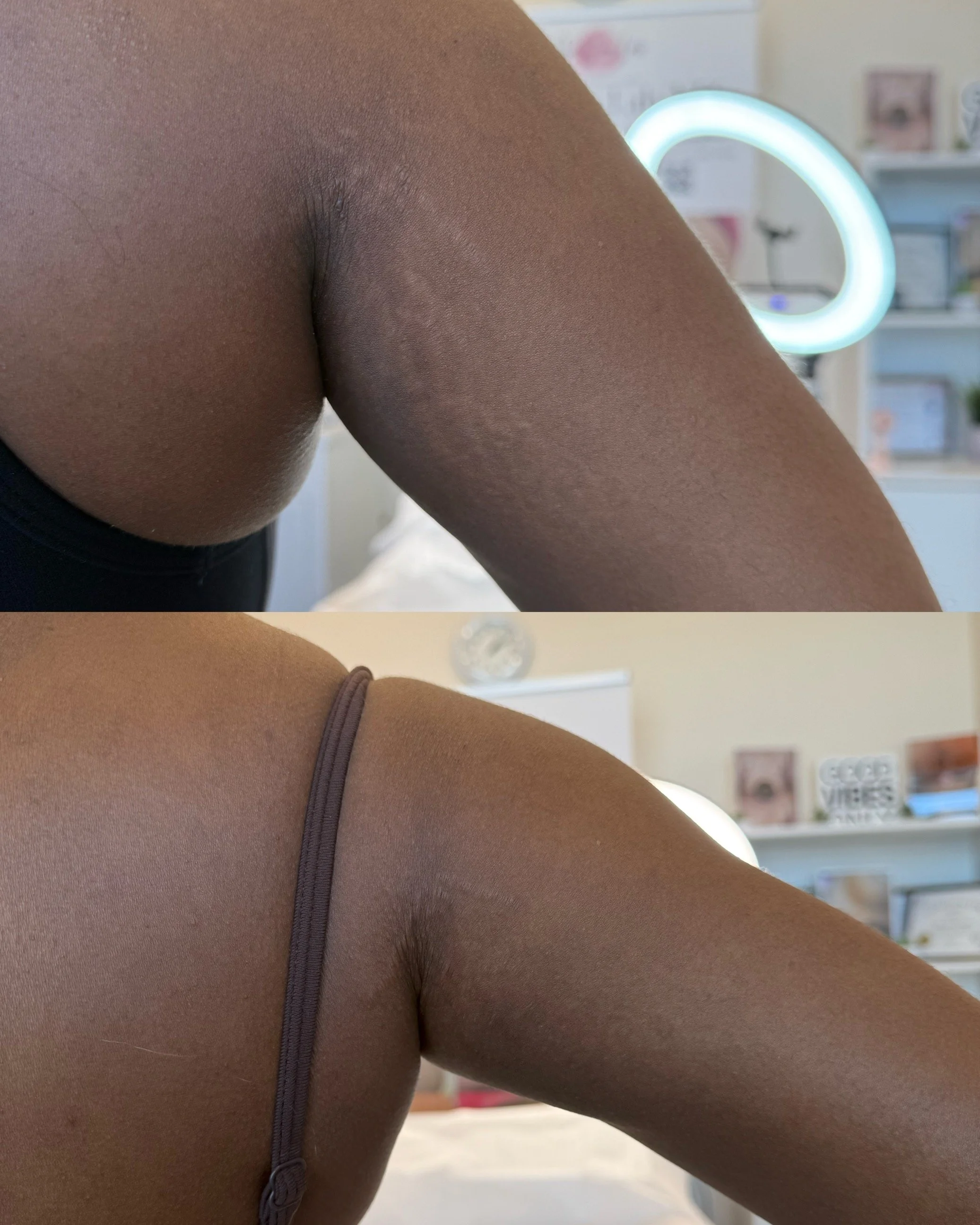 Before and after back of arm stretch marks on melanin rich skin following inkless stretch mark revision, showing improved texture and reduced stretch mark visibility.