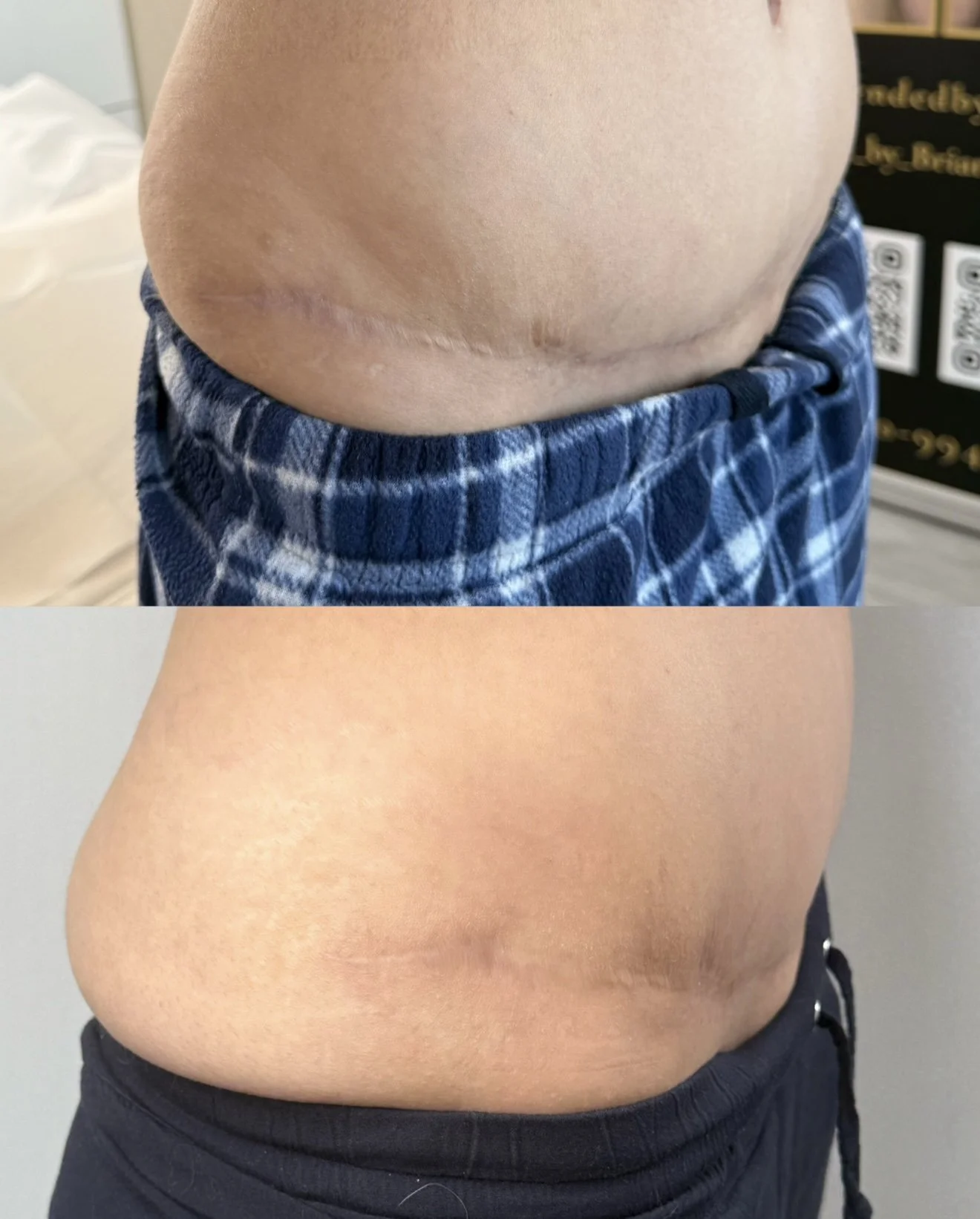 In progress before and after tummy tuck scar camouflage showing improved colour blending and reduced scar visibility.