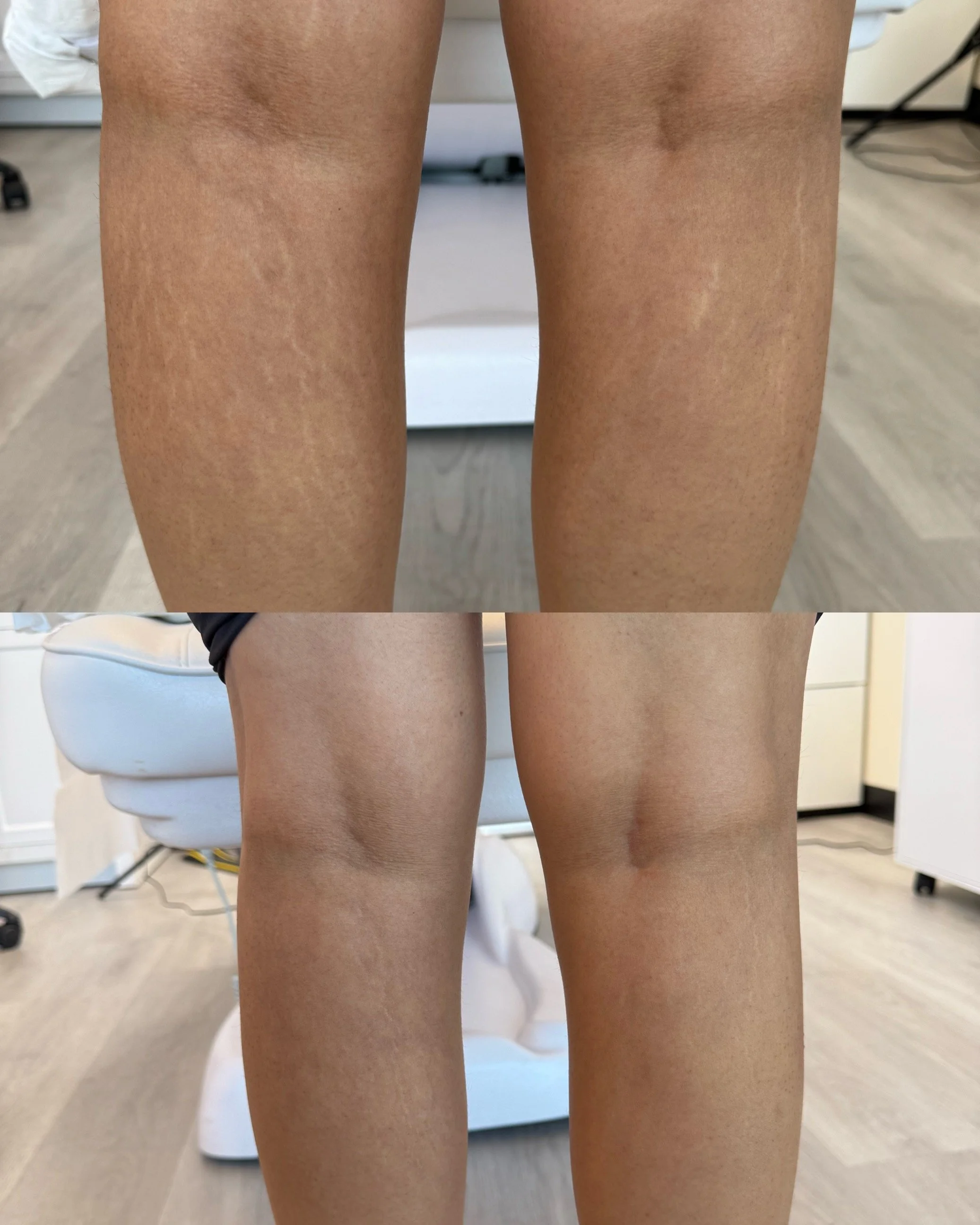Before and after calve stretch marks following inkless stretch mark revision, showing improved skin texture and reduced visibility.