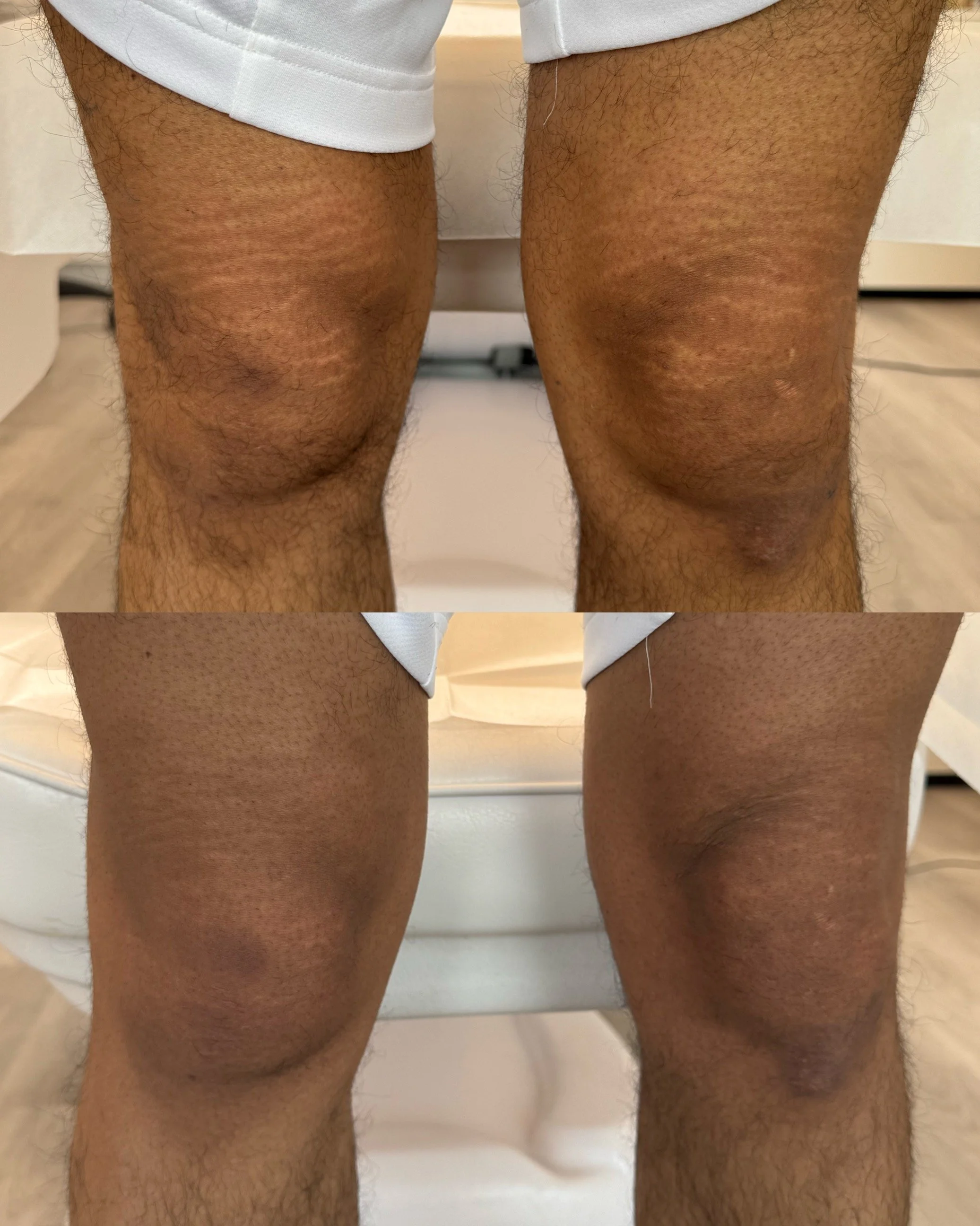 Before and after male knee stretch marks following inkless stretch mark revision, showing improved texture and reduced visibility. 
