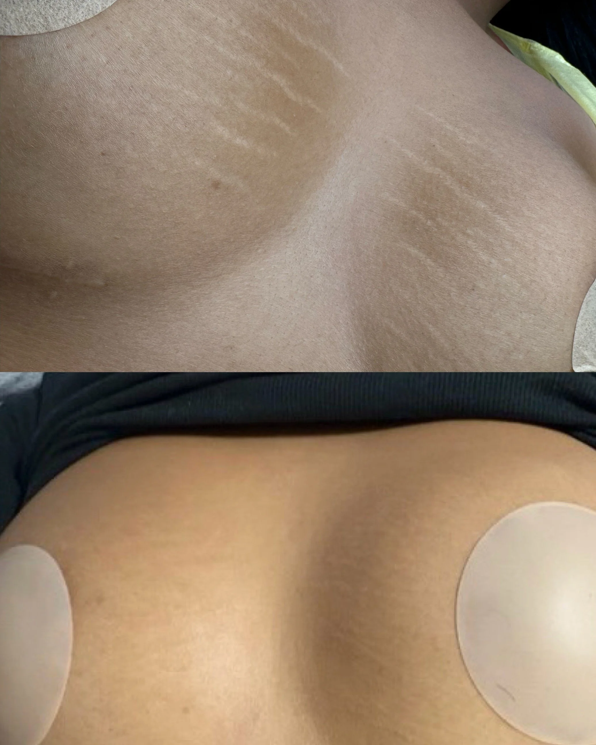 Before and after breast stretch marks following inkless stretch mark revision, showing improved skin texture and reduced stretch mark visibility.