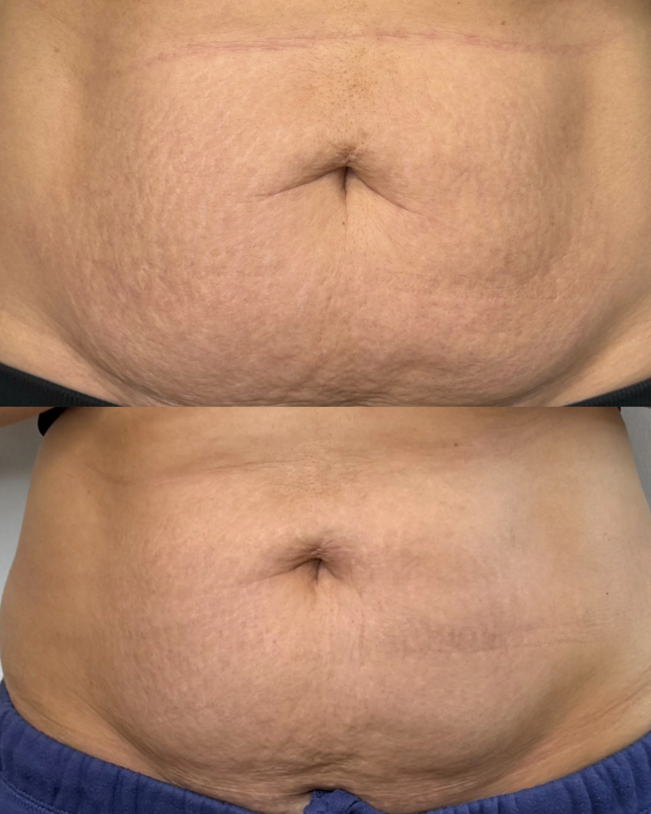 Texture improvement for deep stretch marks in Edmonton, Ab.