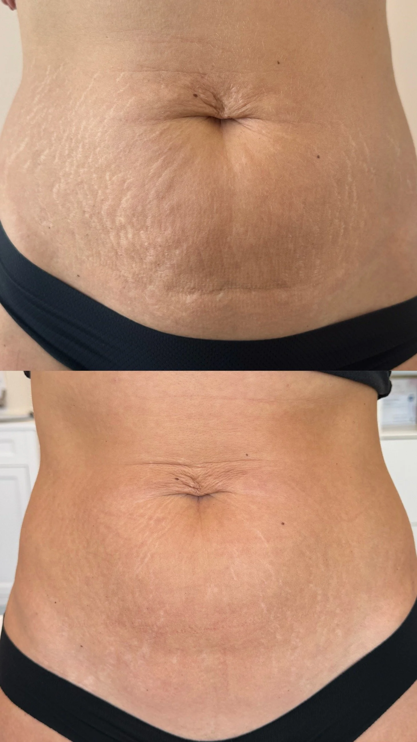 Before and after abdomen stretch marks following inkless stretch mark revision, showing visible
improvement in skin texture and reduced stretch mark visibility.