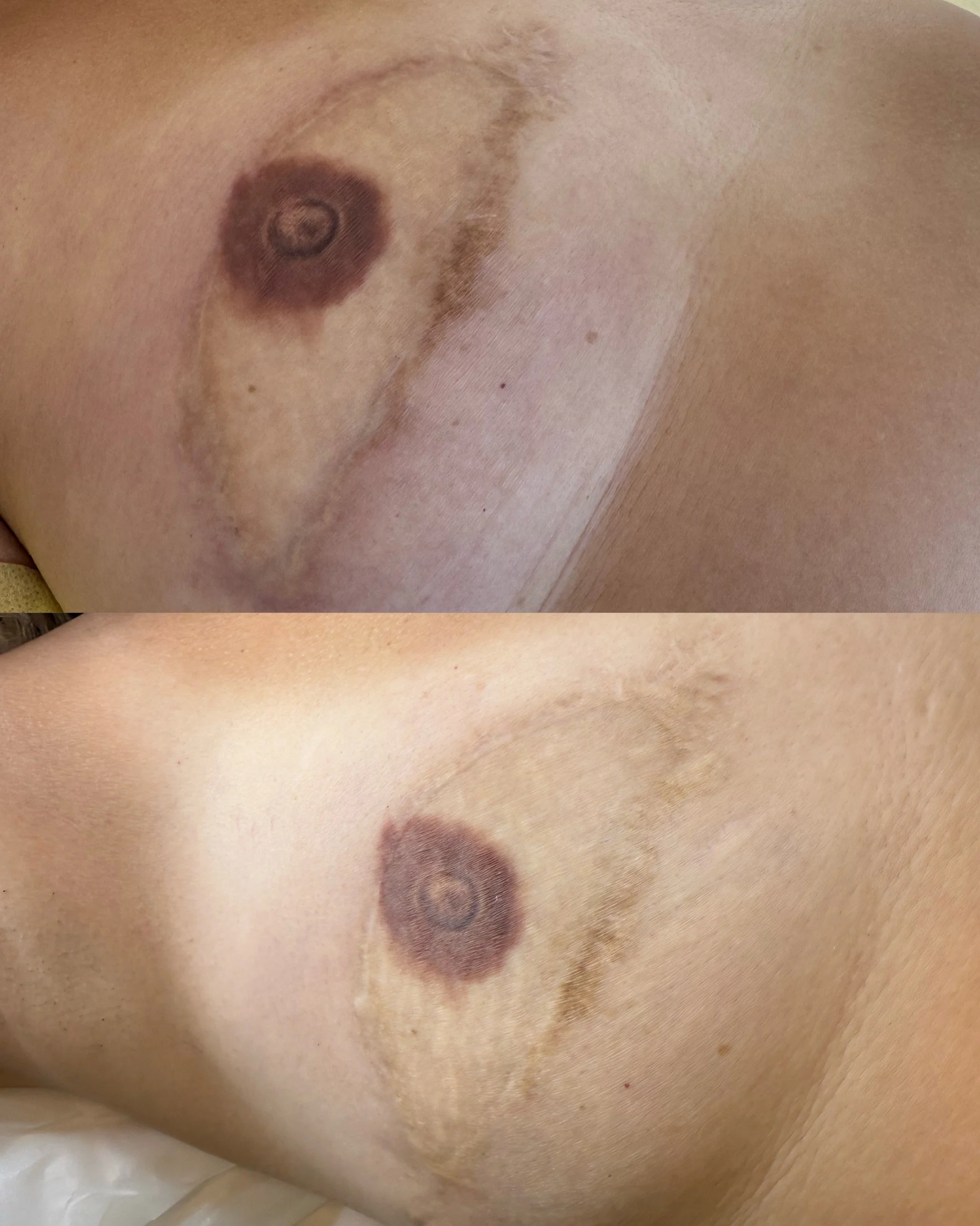 Scar solutions for hyperpigmentation after surgery. Nipple tattoo post mastectomy near me.