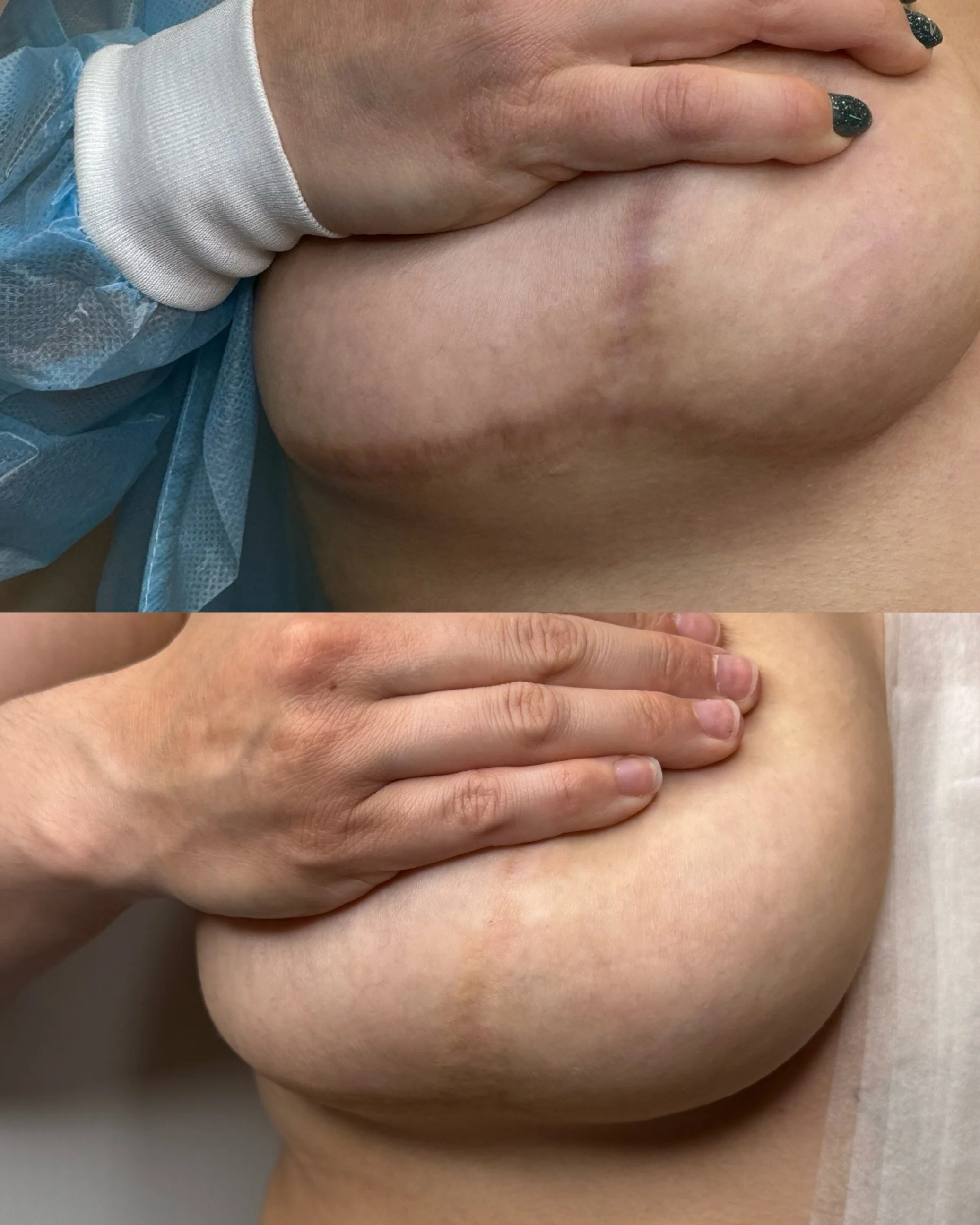 Breast reduction scar solutions near me.