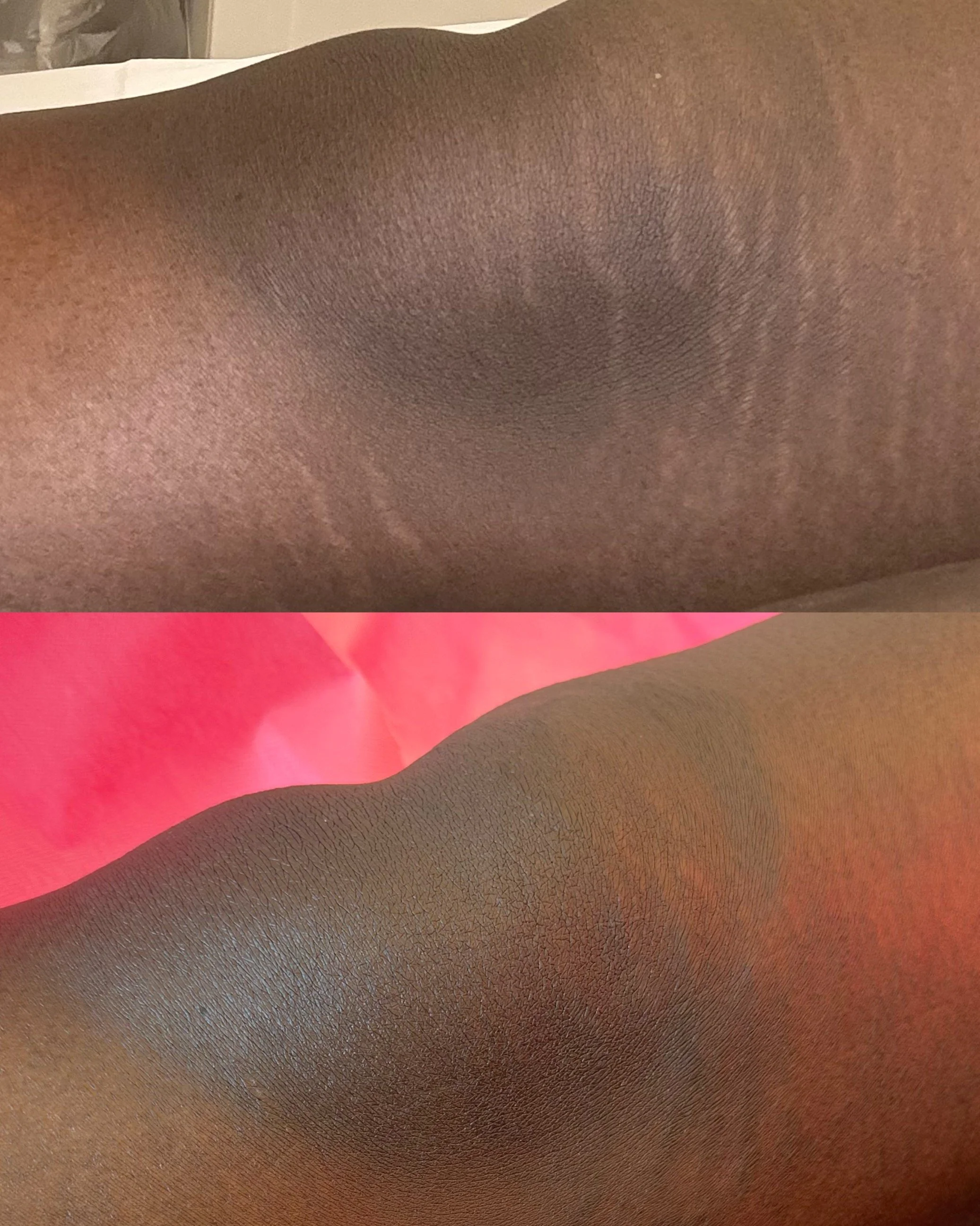 Before and after knee stretch marks on melanin rich skin following stretch mark camouflage treatments, showing improved colour blending and reduced stretch mark visibility.